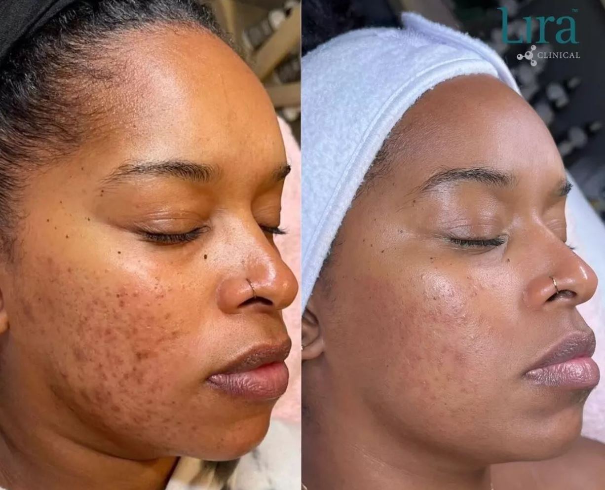 Lira Chemical Peel (Face or Body)
