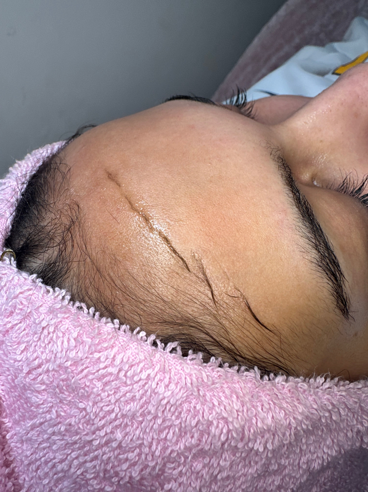 Dermaplaning Facial at Luxury Lounge Esthetics in Washington Courthouse, OH