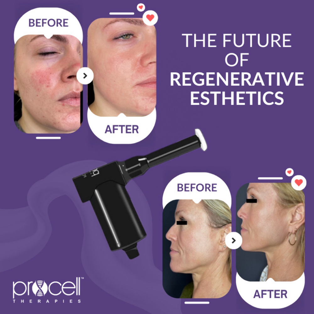 Procell Therapies Microchanneling at Le bel âge Salon & Spa in Conway, AR