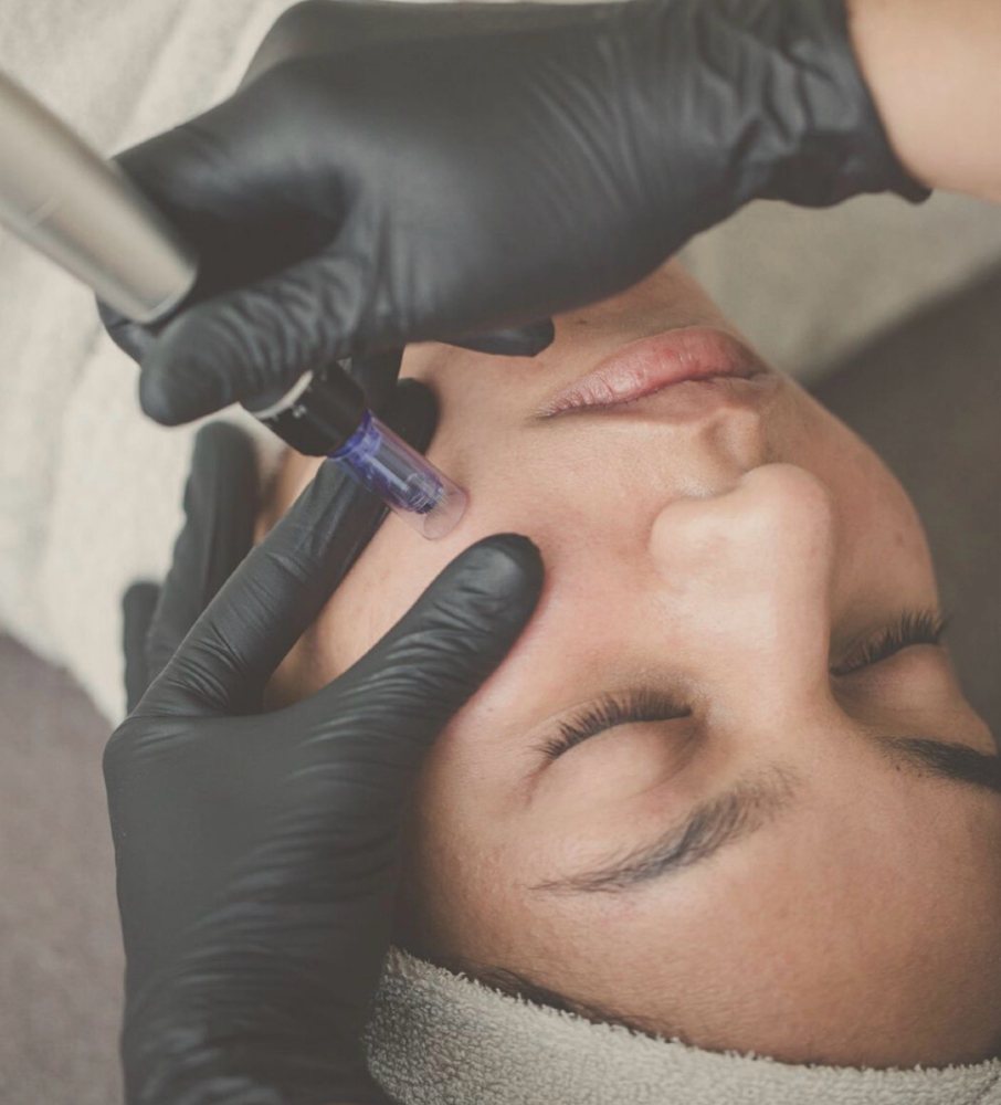 Microchanneling at Skin by Dylan LLC in Atoka, TN