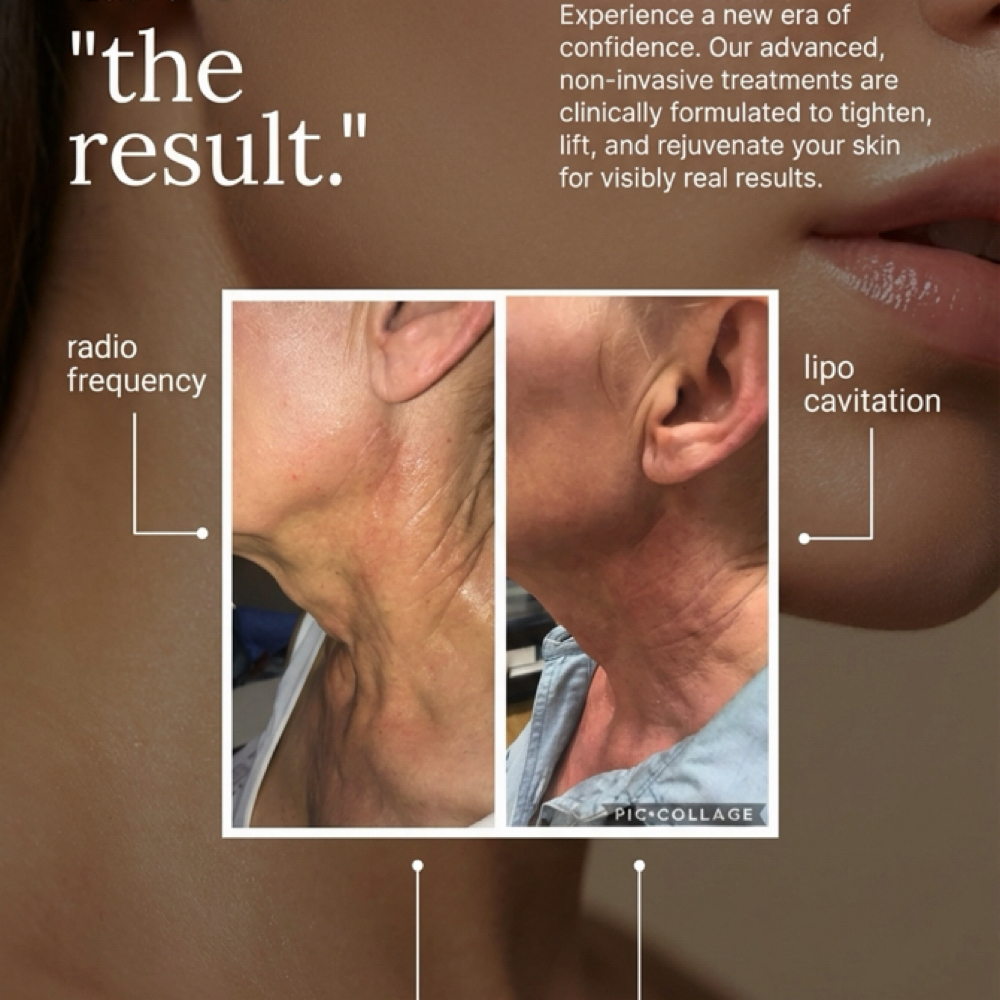 Radio Frequency Skin Tightening at Lisa’s Lil Spa Room in Sioux Falls, SD