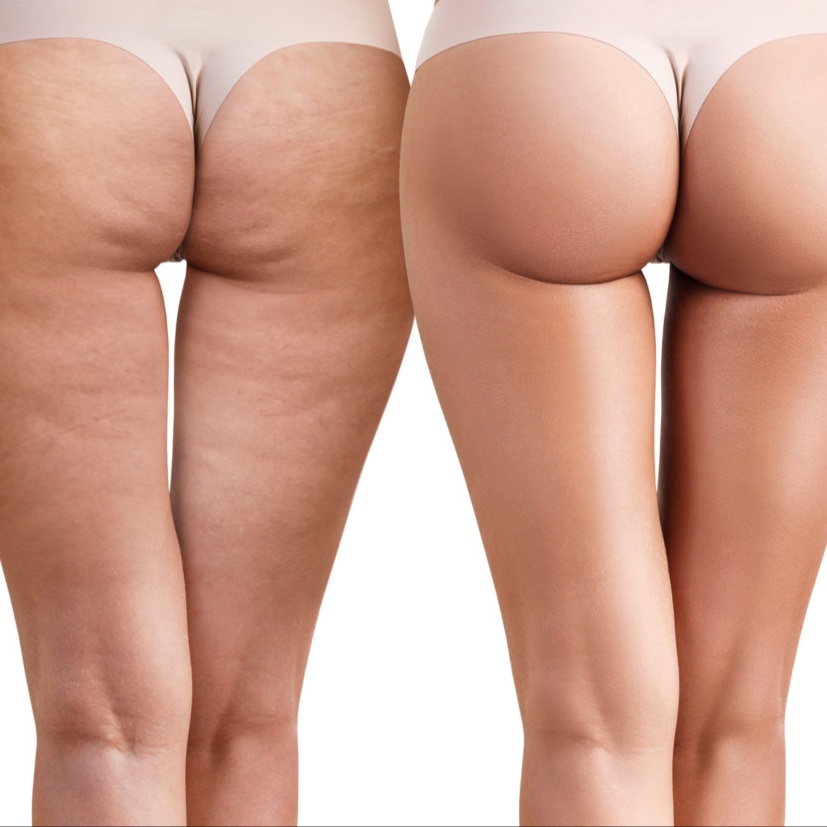 Regenerating Cellulite Treatment at Bliss Beauty Bar in Houston, TX