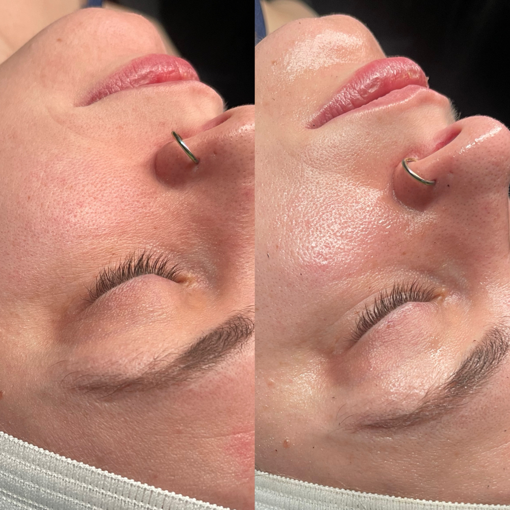 HydraFacial