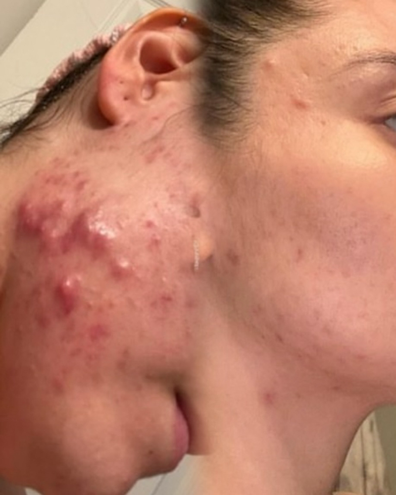 Acne Facial
