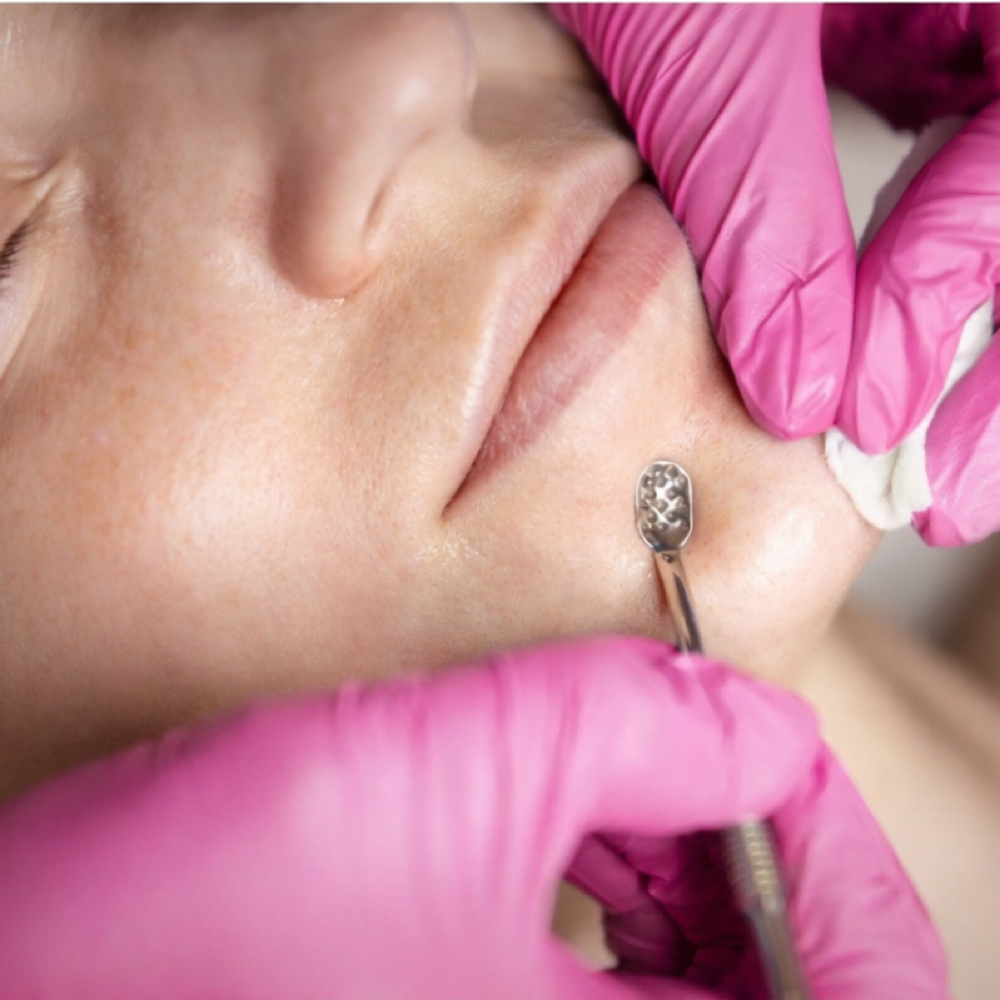 Extraction at Image Salon and Esthetics in Newark, OH