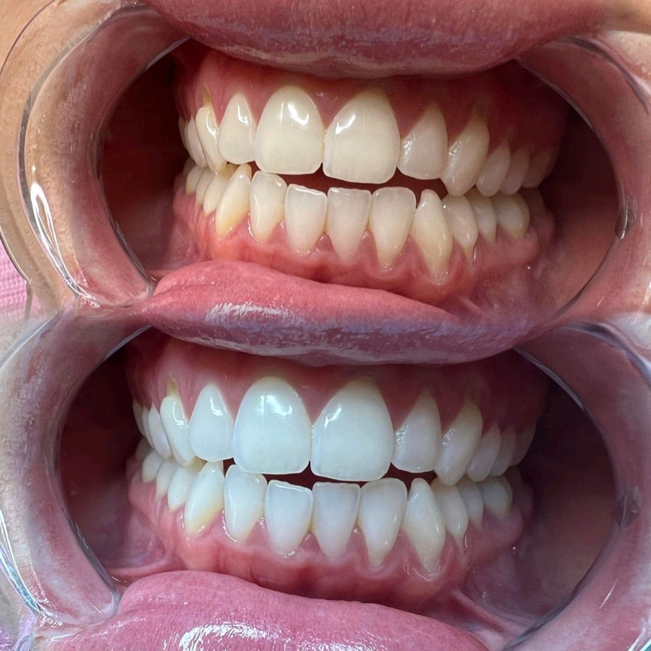 40 min Iconic Teeth Whitening at Hollywood Smiles409 Cosmetic Teeth Whitening in Beaumont, TX