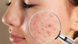 Acne Facial