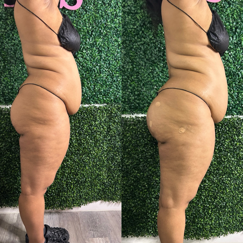 3D Liquid at HVS BODY in Shaker Hts, OH