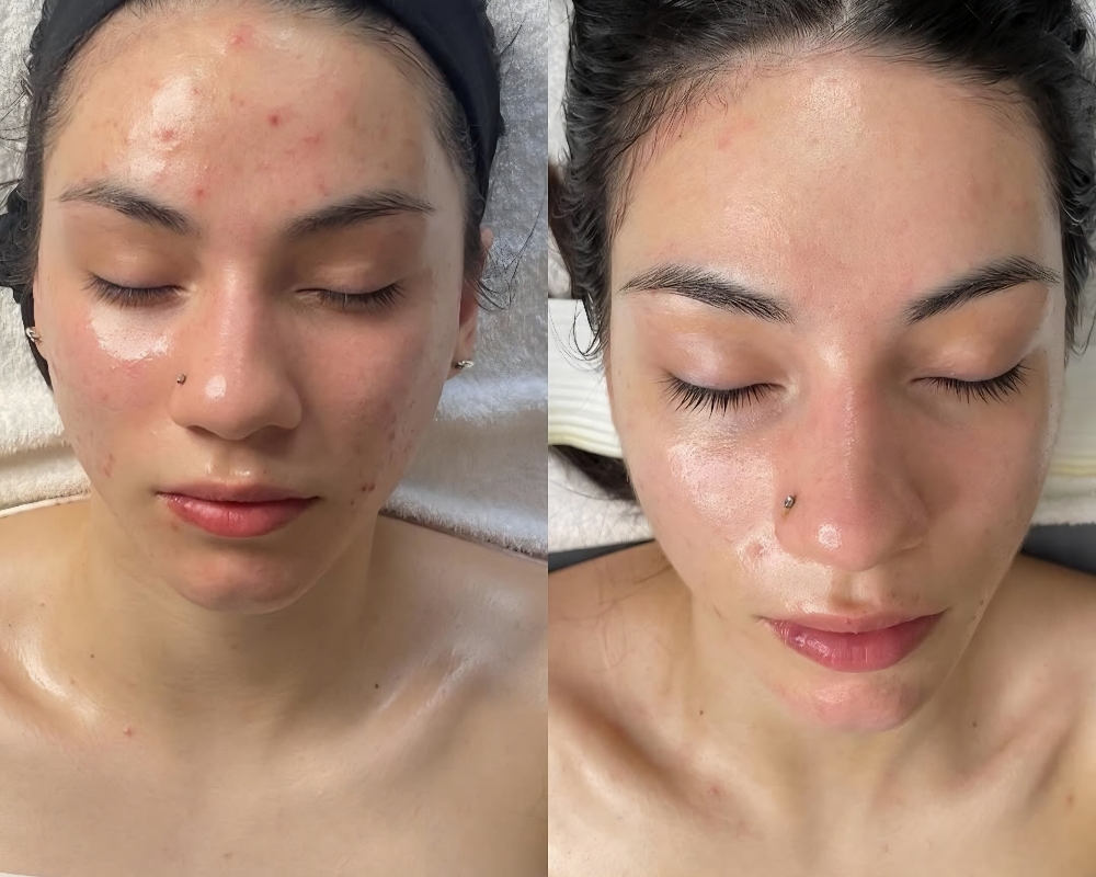 Acne Facial with Extractions