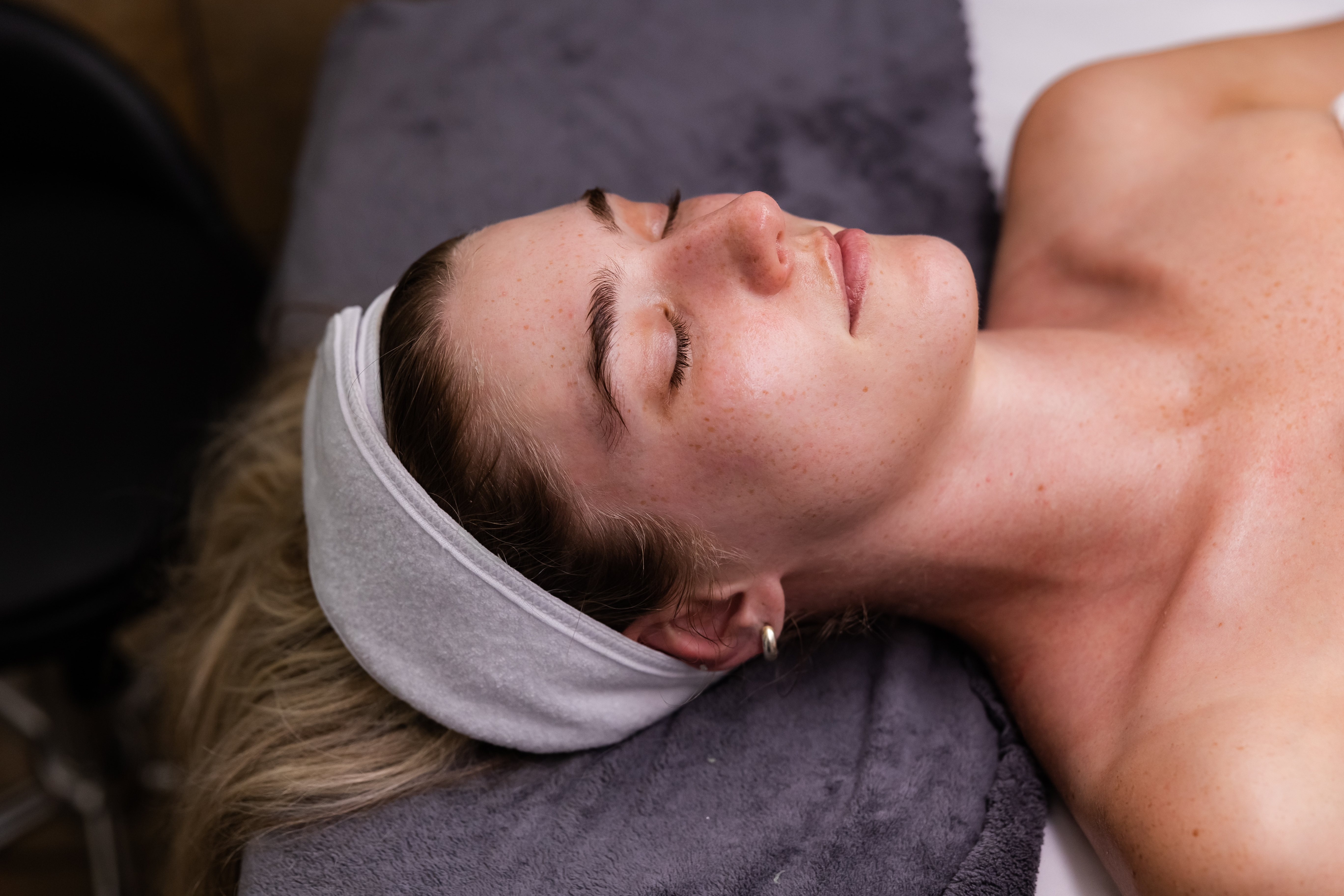 Chemical Peel
