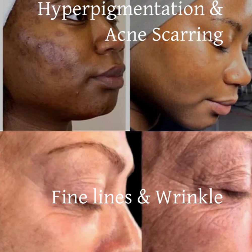 Dermal Advance Treatment at Potent Transitions in East Orange, NJ