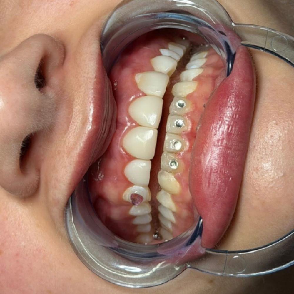 Tooth Gem Standard at Alyssa Rene Esthetics in Lewiston, ID