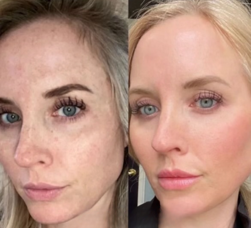 Ultra - Melasma