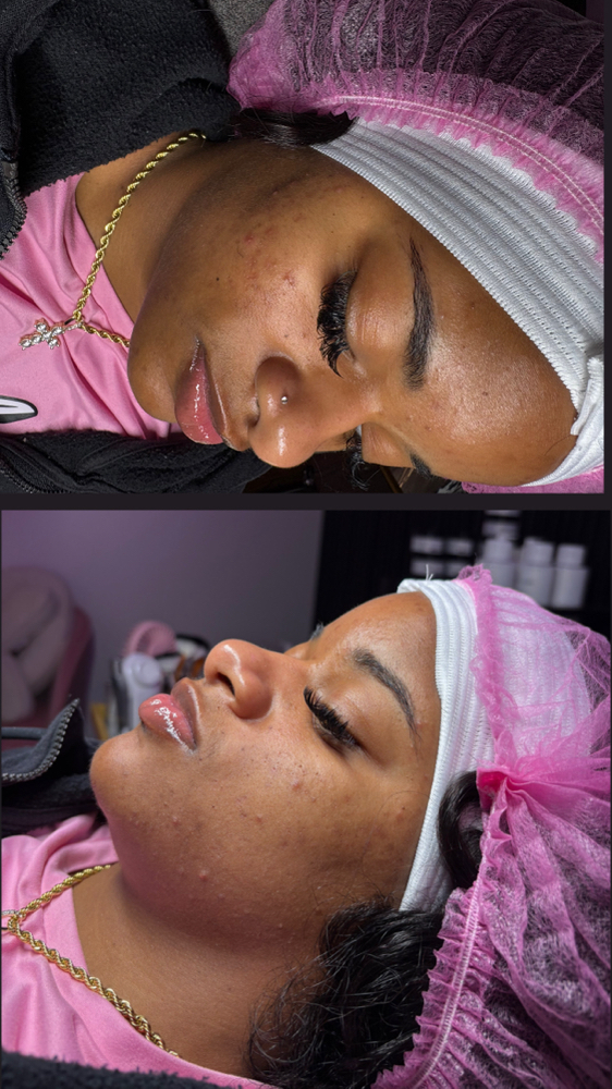 Acne RX 2.0