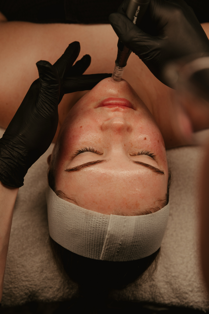 3 Microneedling Treatments