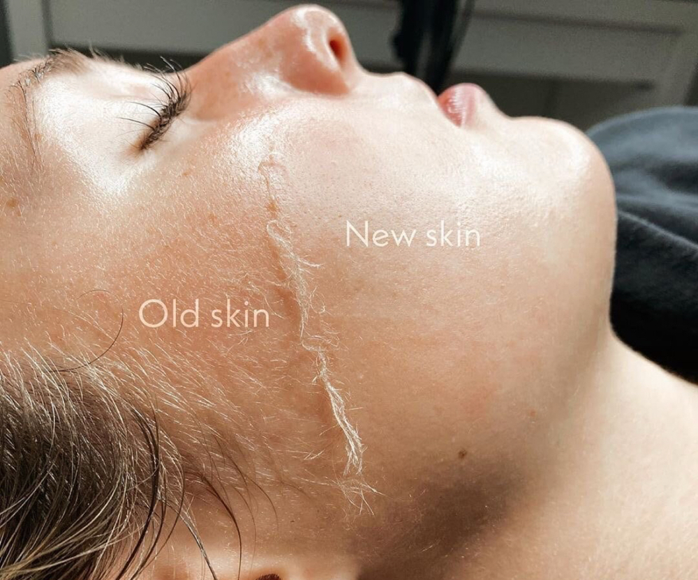 Dermaplane Facial