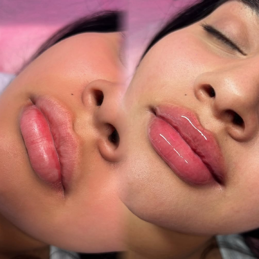 Hylaron Pen Lip Filler at Body By vicky in Corpus Christi, TX