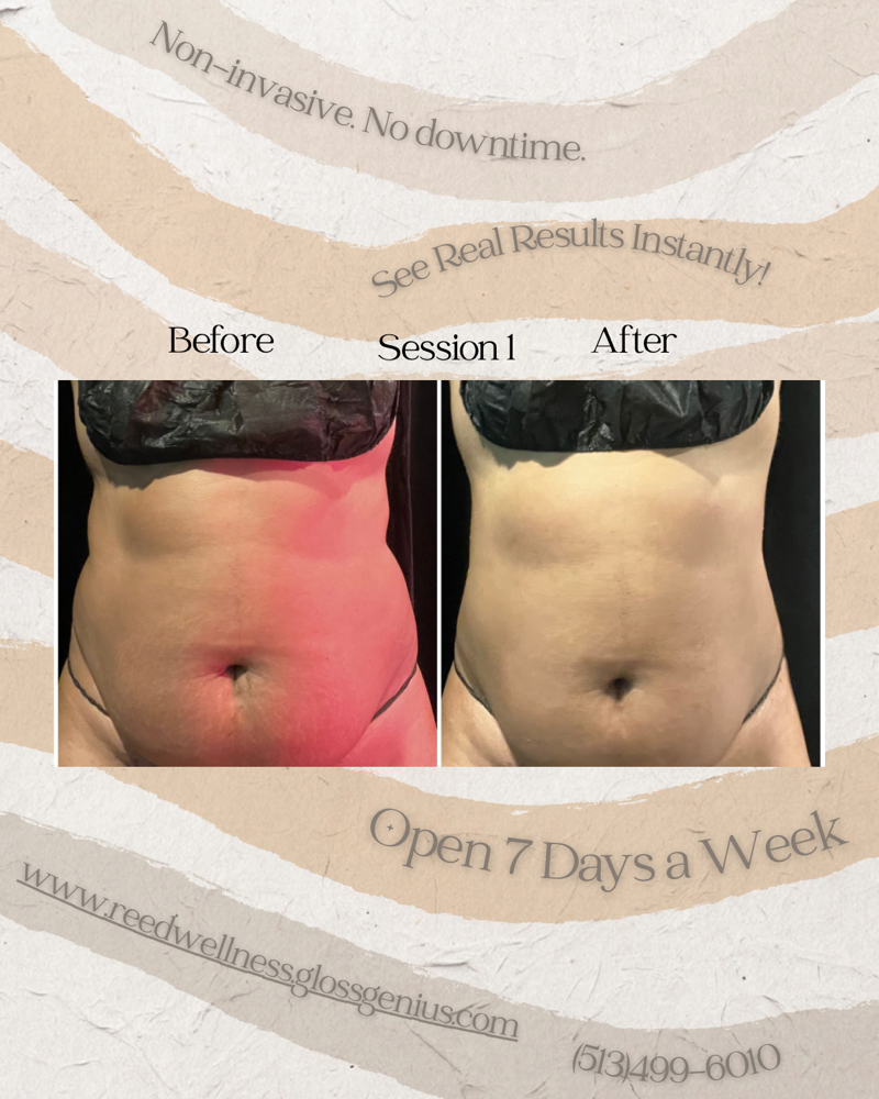 Lipo Cavitation