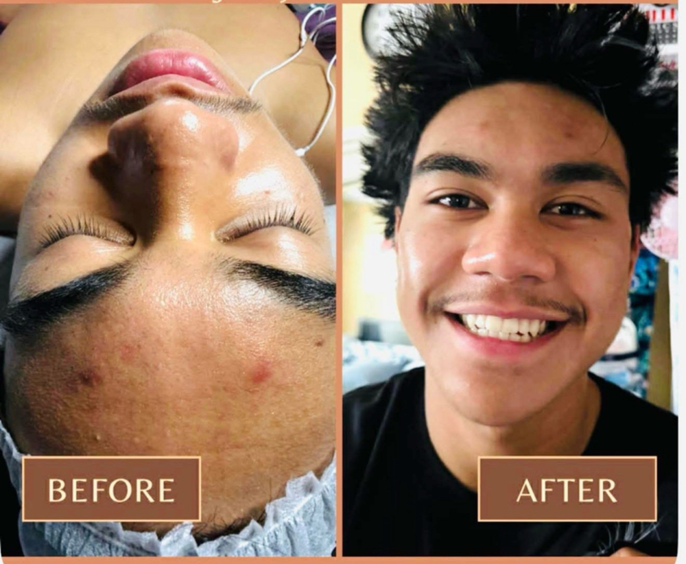 ACNE TREAMENT at Blooms & Beauty Esthetics INC in Orlando, FL