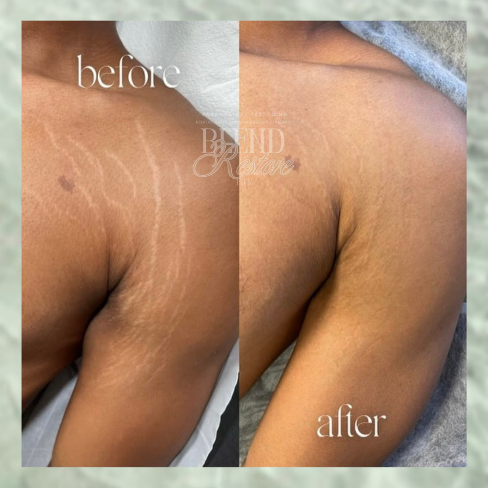 1 Area Stretch Marks