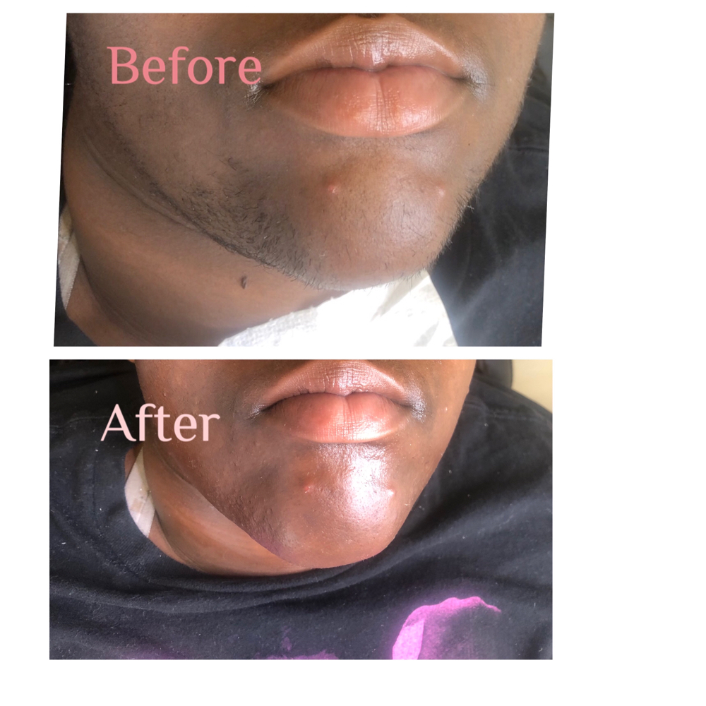 Chin  Or Neck Threading/waxing