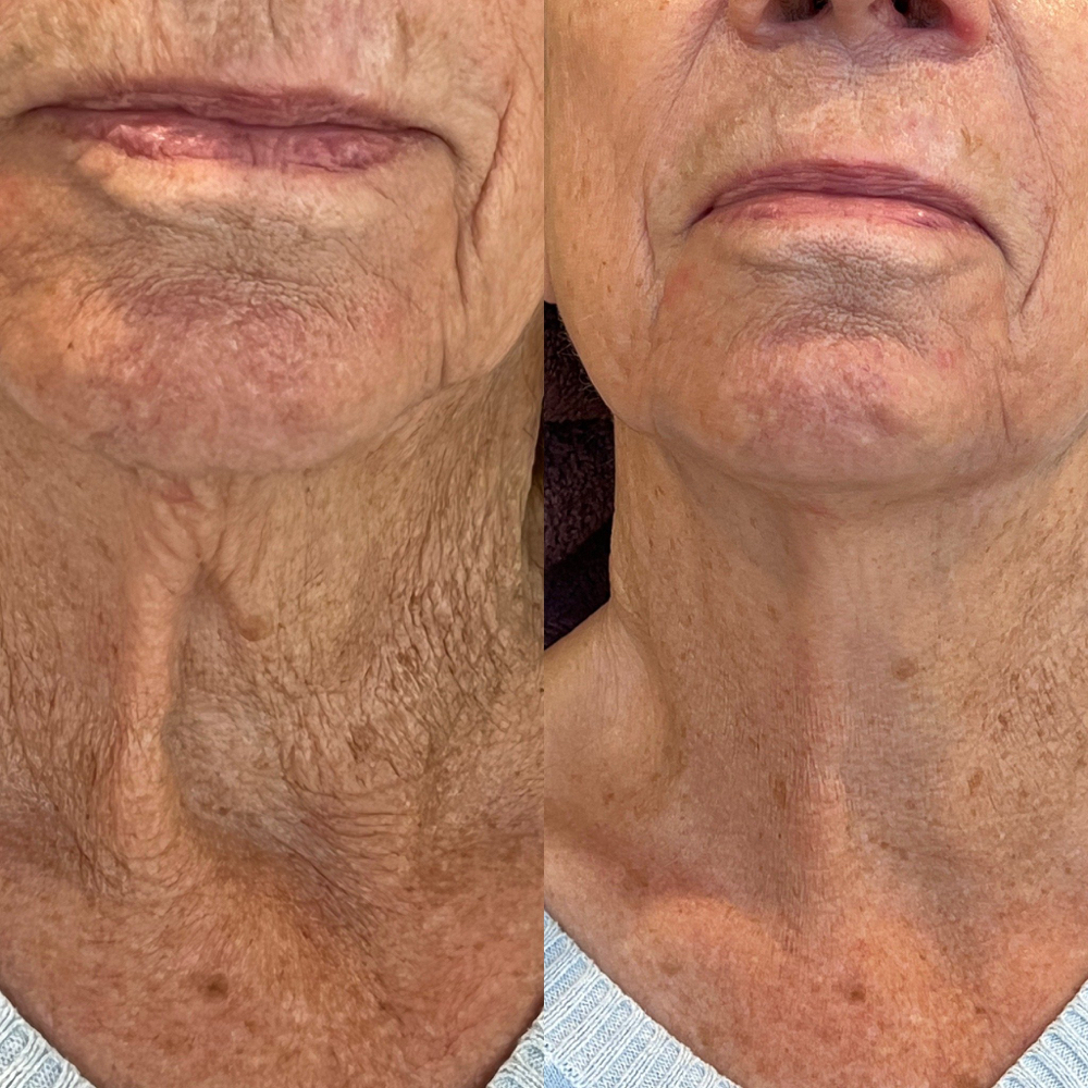 Procell Microchanneling (Face+Neck)