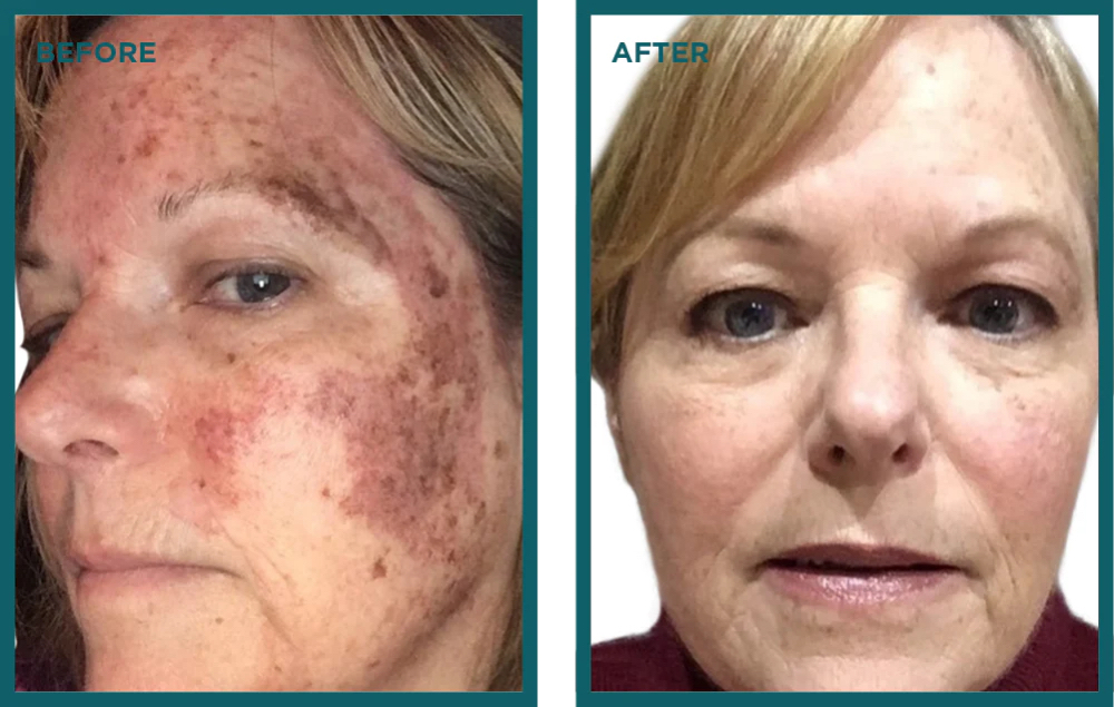 VIPL-3 VI Peels And 3 Full Face IPL