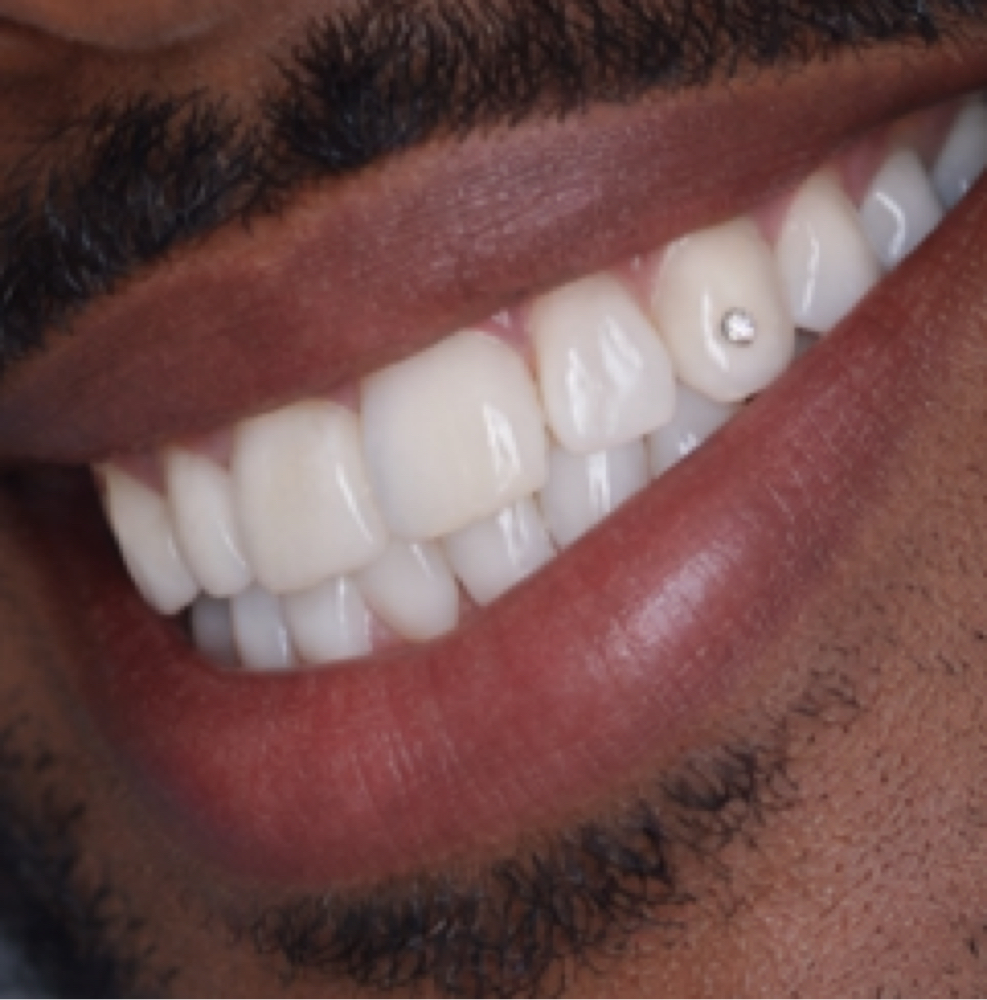 Diamond Tooth Gems at Tooth Gemz & Forever Jewelry by Victoria LLC in Grants Pass, OR