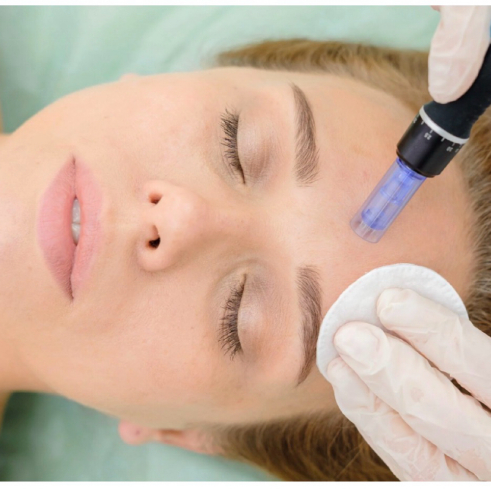 MICRONEEDLING HA at Remake Beauty Studio Mission in Mission, TX