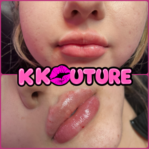 2 ML Lip Filler