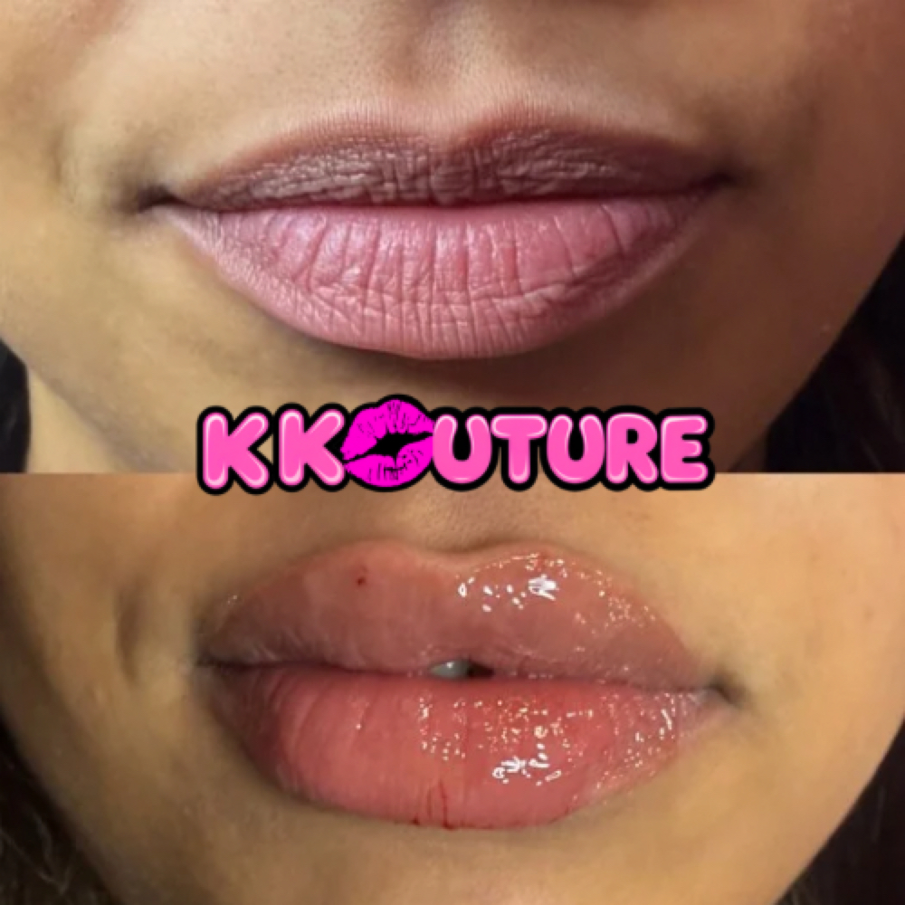 2 ML Lip Filler at k kouture in Fort Worth, TX