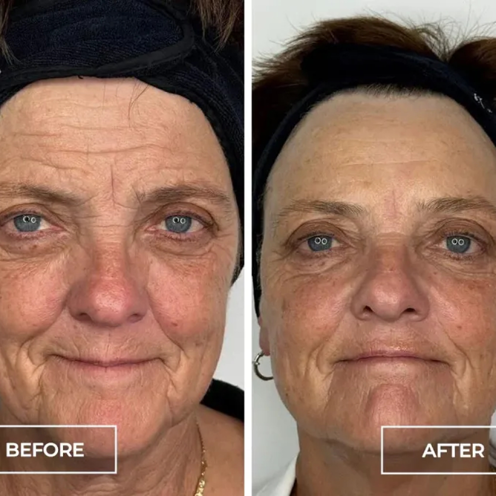 SWiCH Facial Treatment