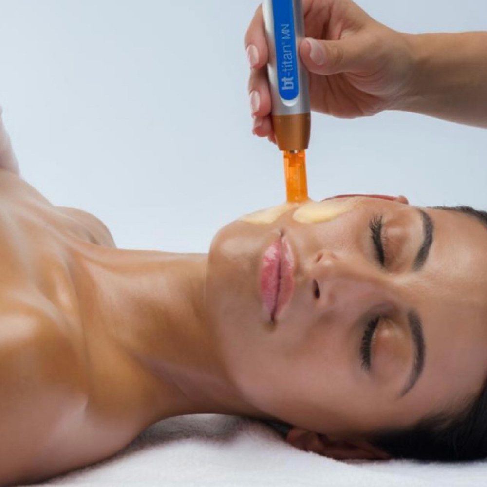 Bt-Titan MN Microexfoliation at Graceful Skin Facial Studio in Magnolia, TX