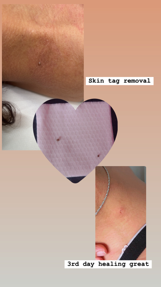 Skin Tag Removal