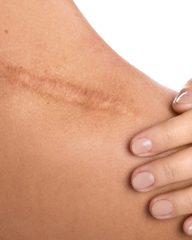 Scar Treatment