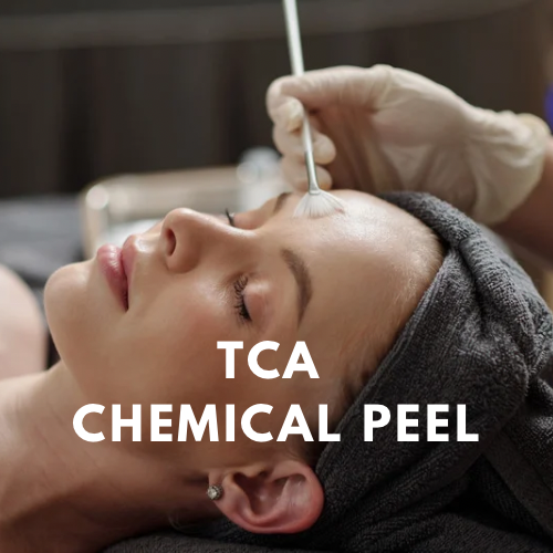 TCA Chemical Peel