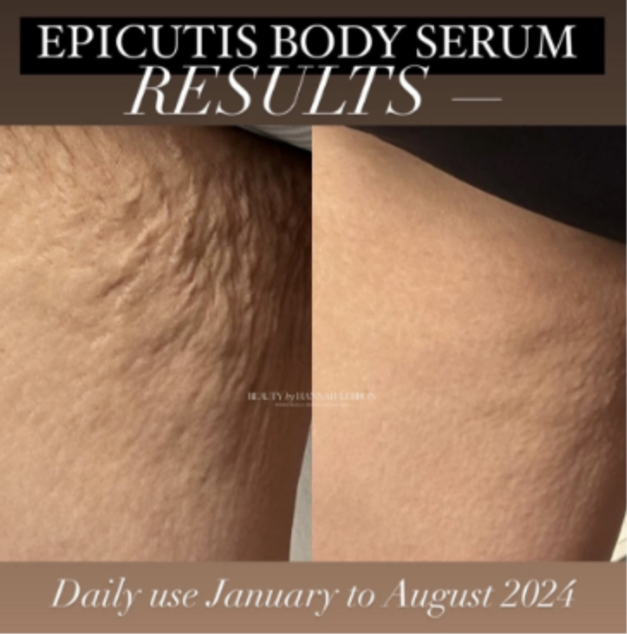 Epicutis Lipid Body Treatment