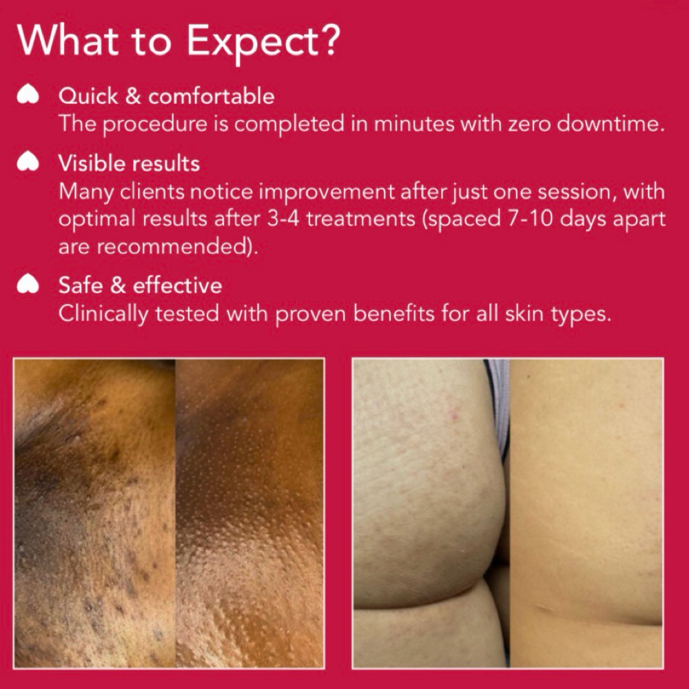 BioRePeel Treatment at BellaRose BEAUTique in Rowlett, TX