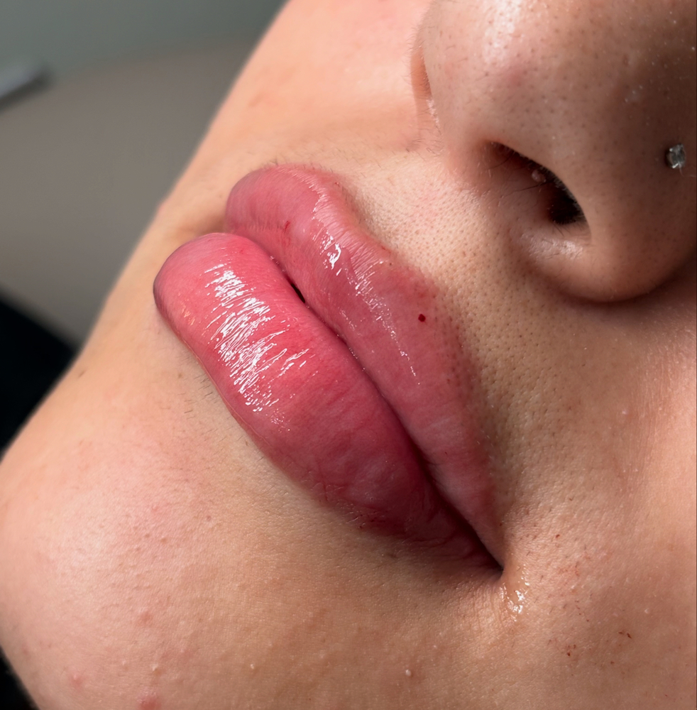 Kysse Half Syringe at Aura Skin x Marissa in Alice, TX