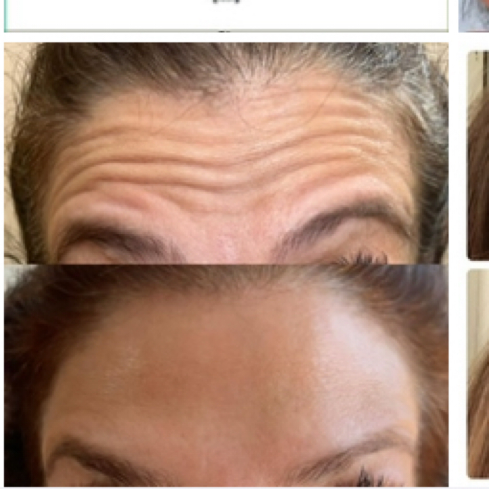 Botox- Forehead -No Glabellar Lines at Groomsology by Amanda Nicole in Mt Orab, OH