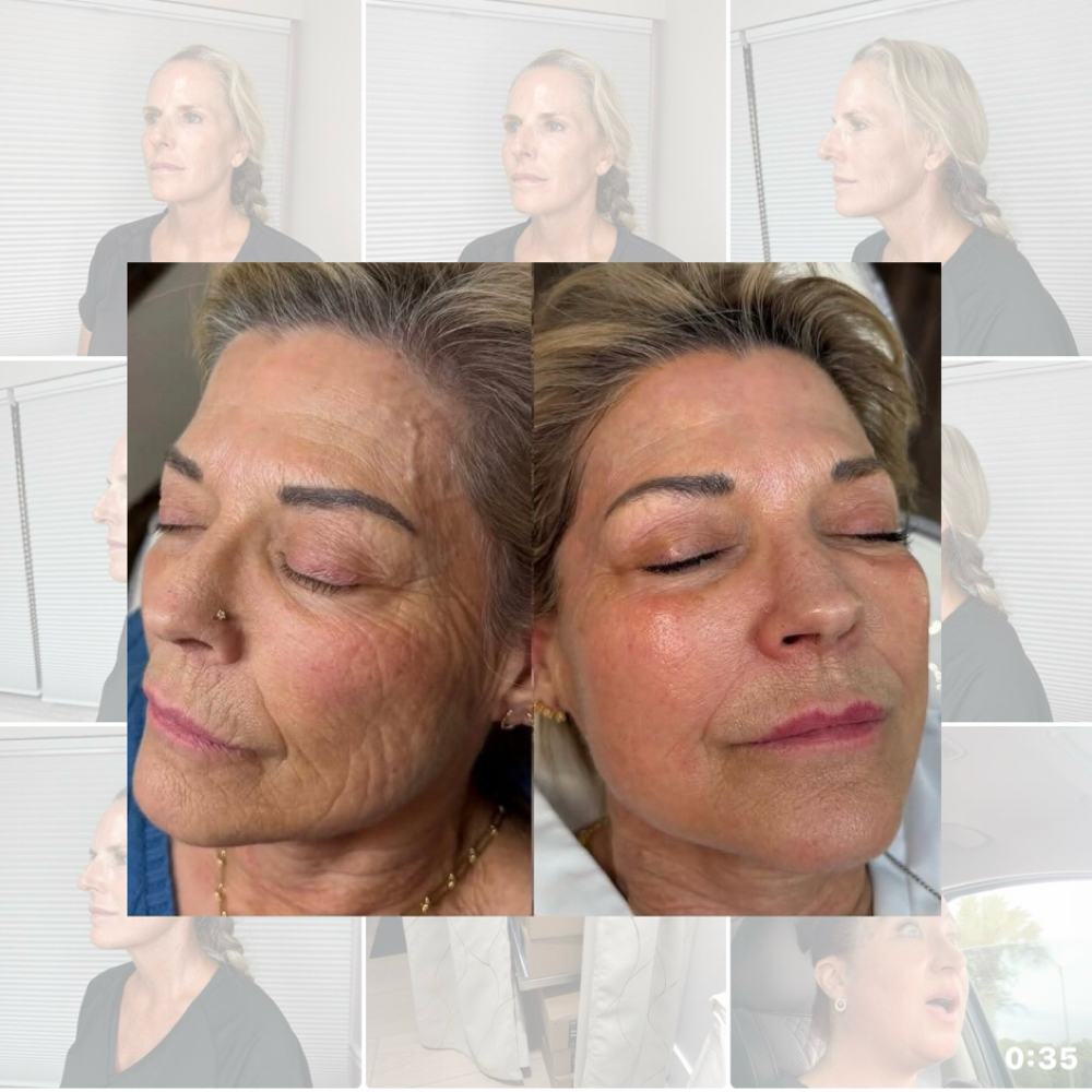 PRX - PLUS w/ Brighten-Face & Neck at Marco Island Aesthetics in Marco Island,, FL