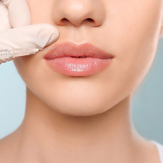 Lip Flip at Athena Med Spa in San Antonio, TX