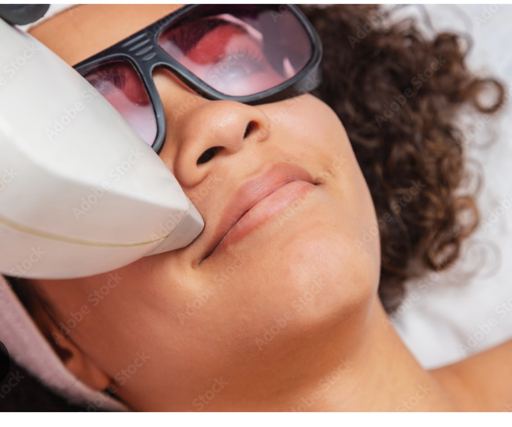 Laser Hair Removal  Upper Lip