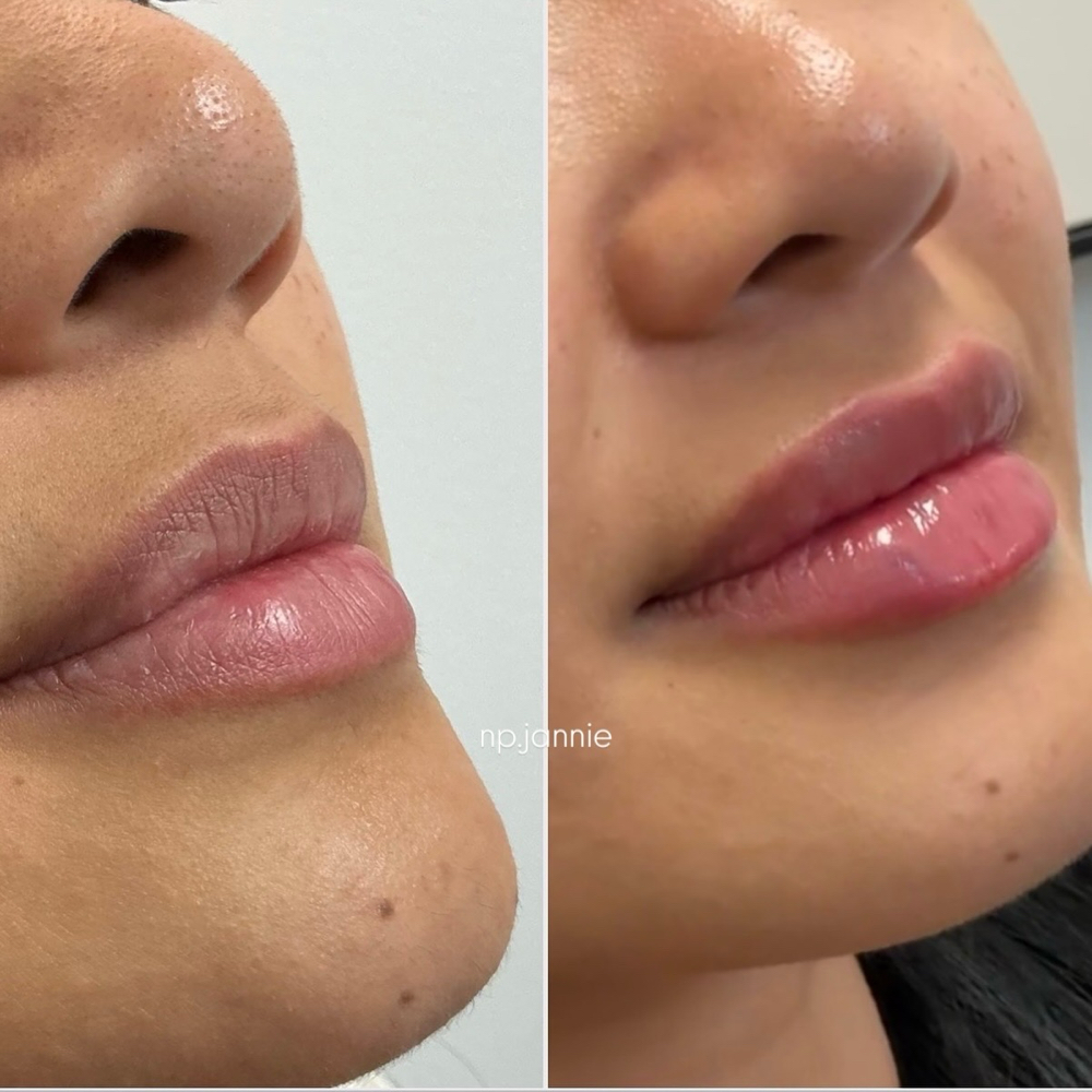 Lip Filler