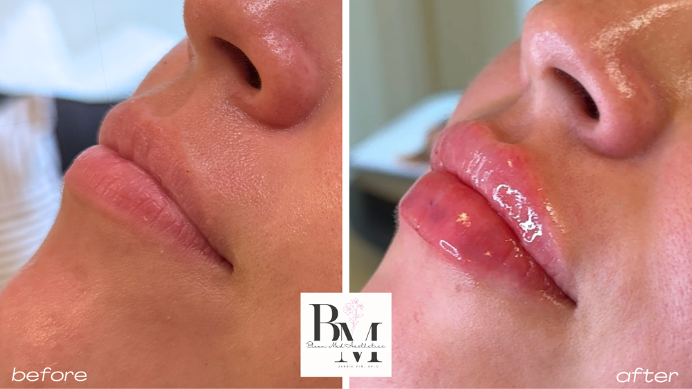 Lip Filler