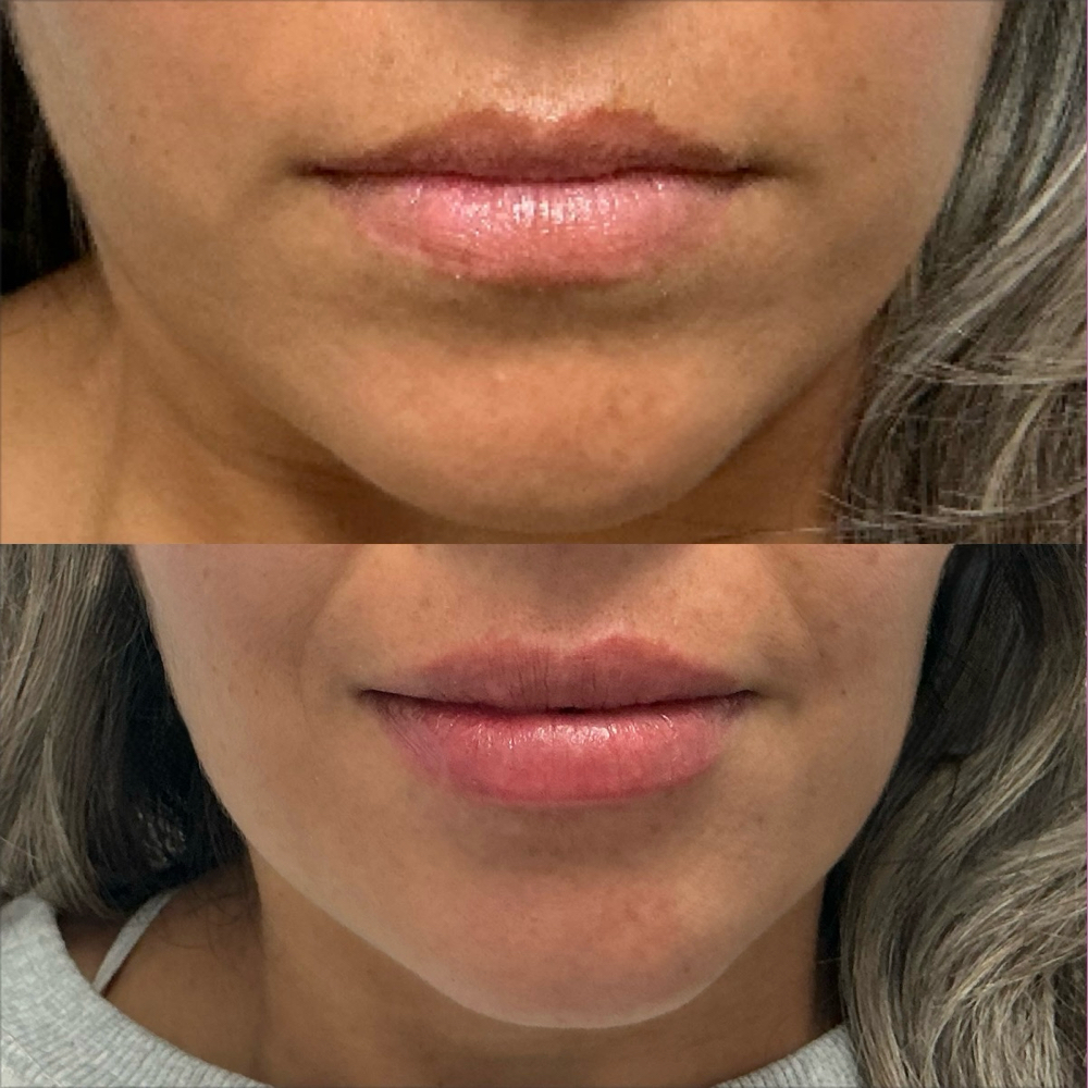 Lip Filler