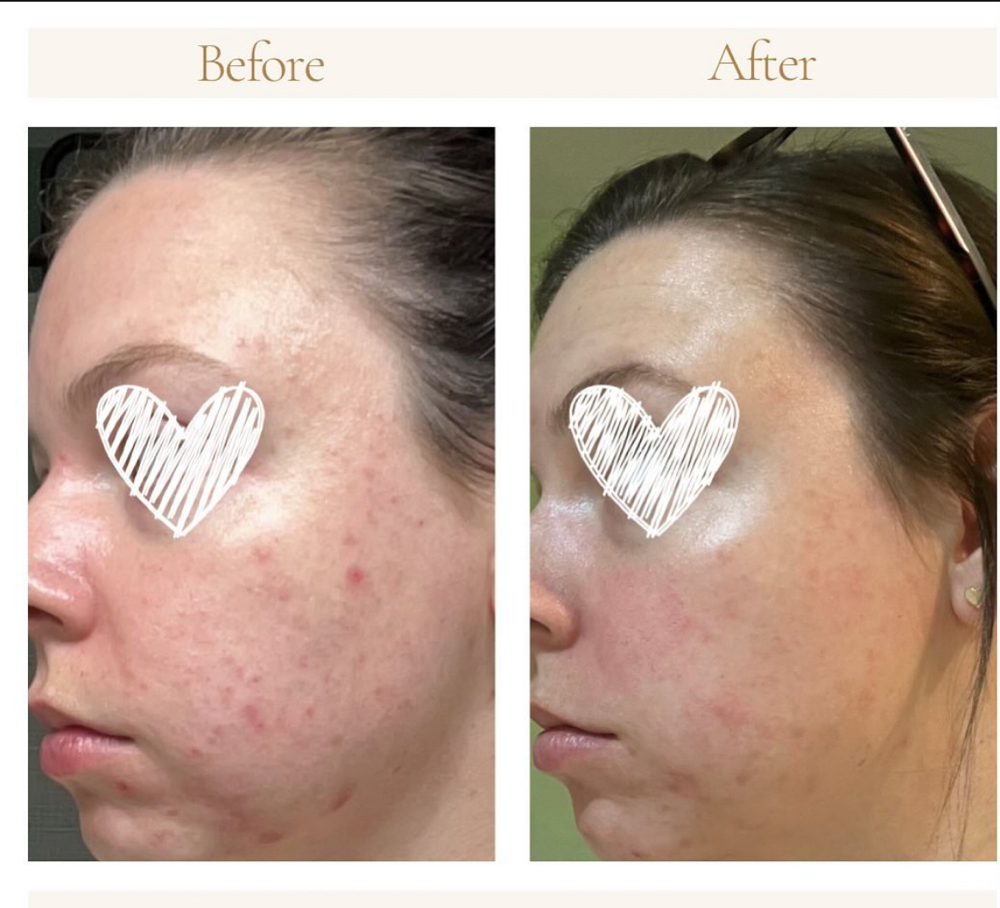Acne Facial
