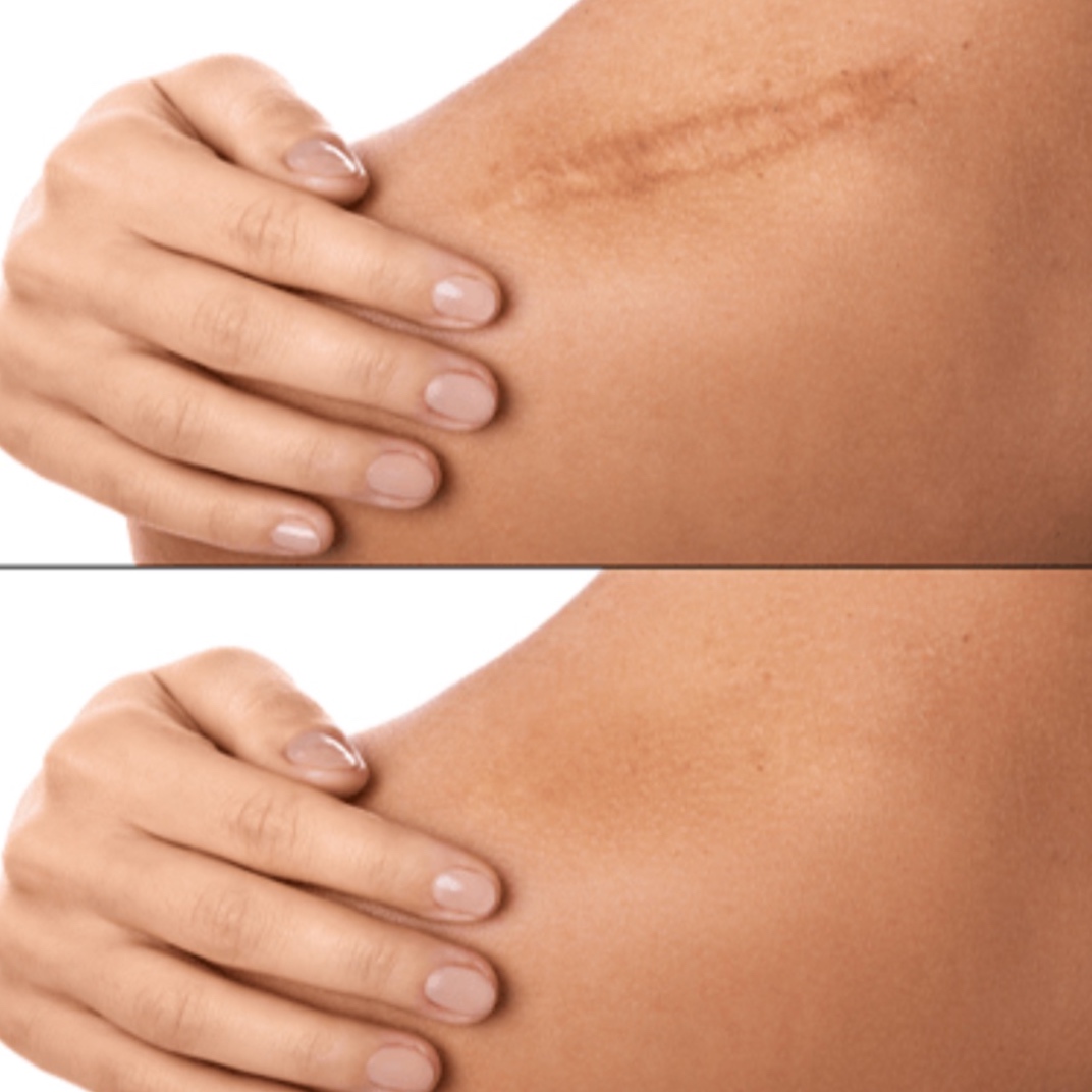 Scar Camouflaging at ARTISTREE in BEL AIR, MD