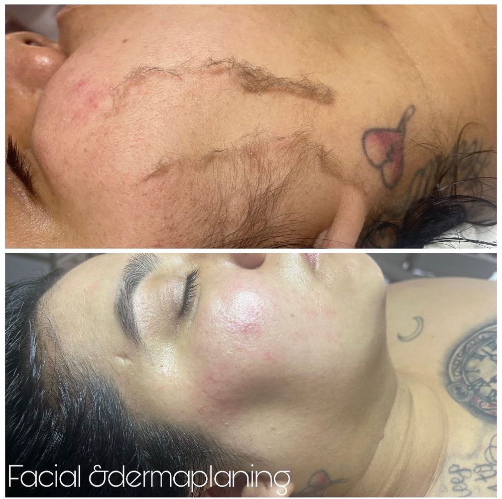 Facial&hydrojelly&dermaplanning