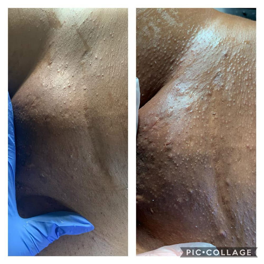 Ingrown Treatment W/ Vajacial at Your Local Coochie Waxer in Louisville, KY
